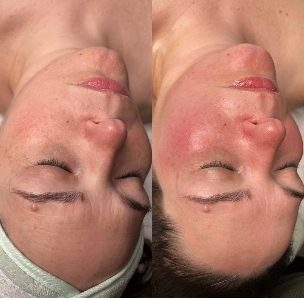 Customized Facial