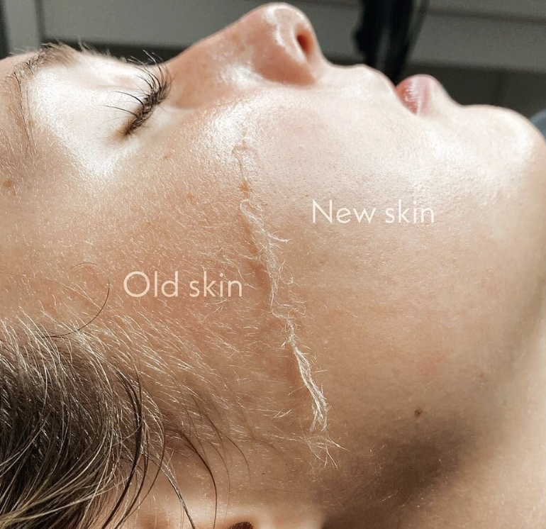 Dermaplaning treatment