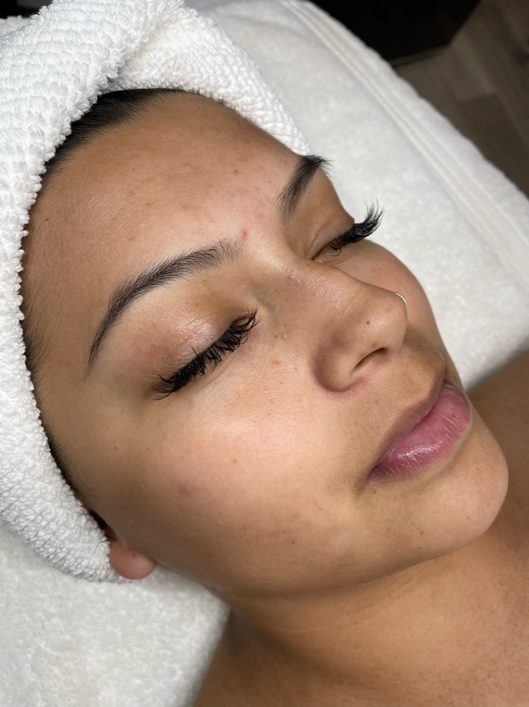 Microdermabrasion Facial