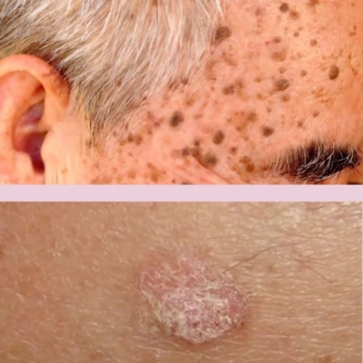 Keratoses Removal at Serenity Aesthetics by Denise in St. John’s, FL