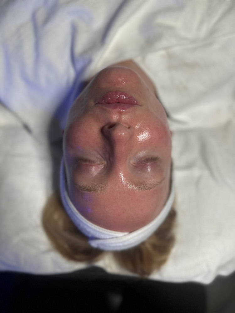 Lucid Theorem Acne Facial