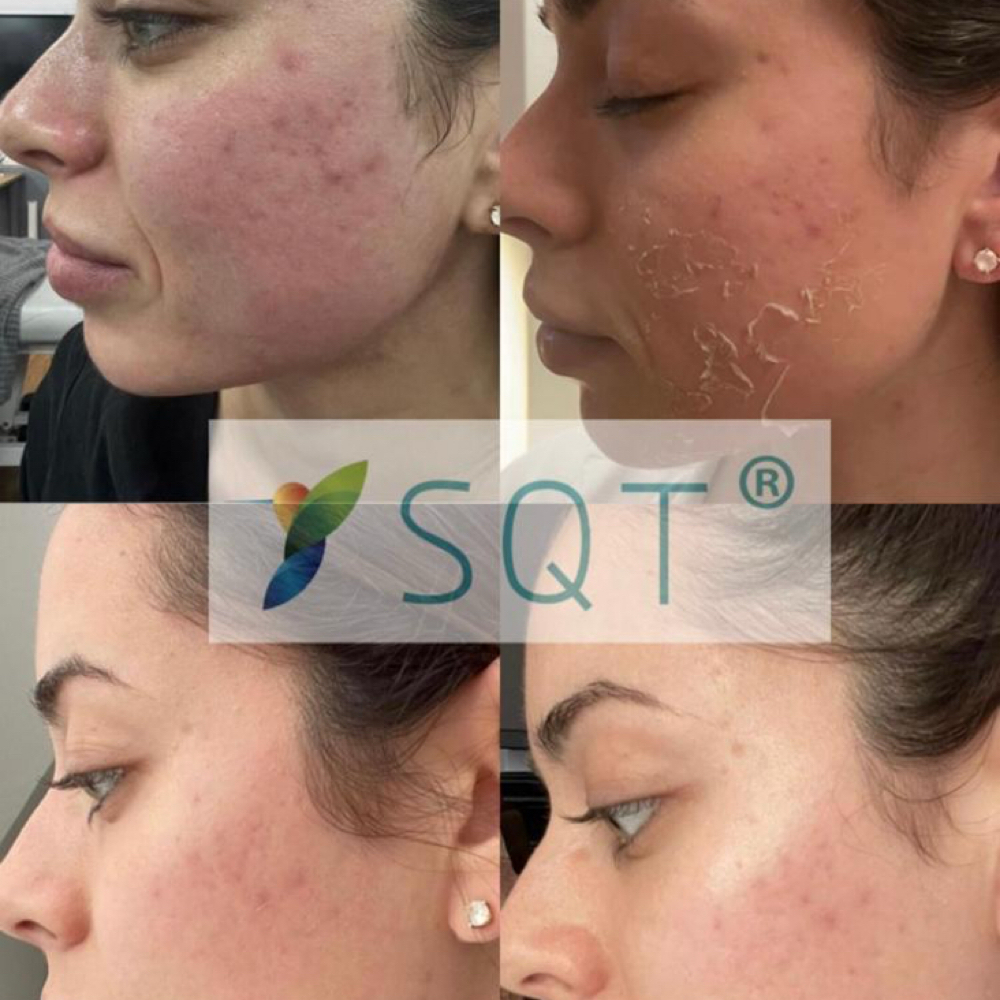 SQT Resurfacing Bio-Needling at Maleeka Beauty & Spa Salon in Roswell, GA