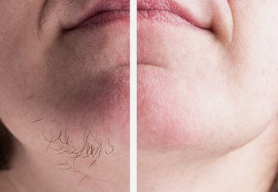 Waxing - Chin
