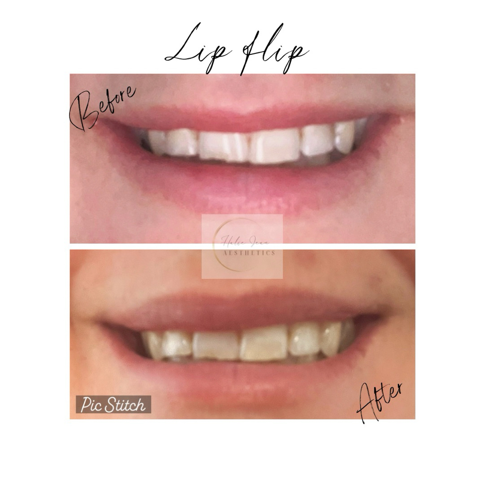 Lip Flip at Halie Jean aesthetics in Marlborough, MA