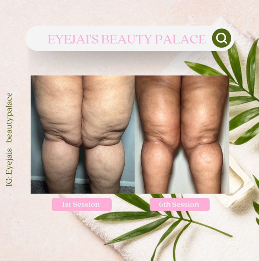 Cellulite Reduction