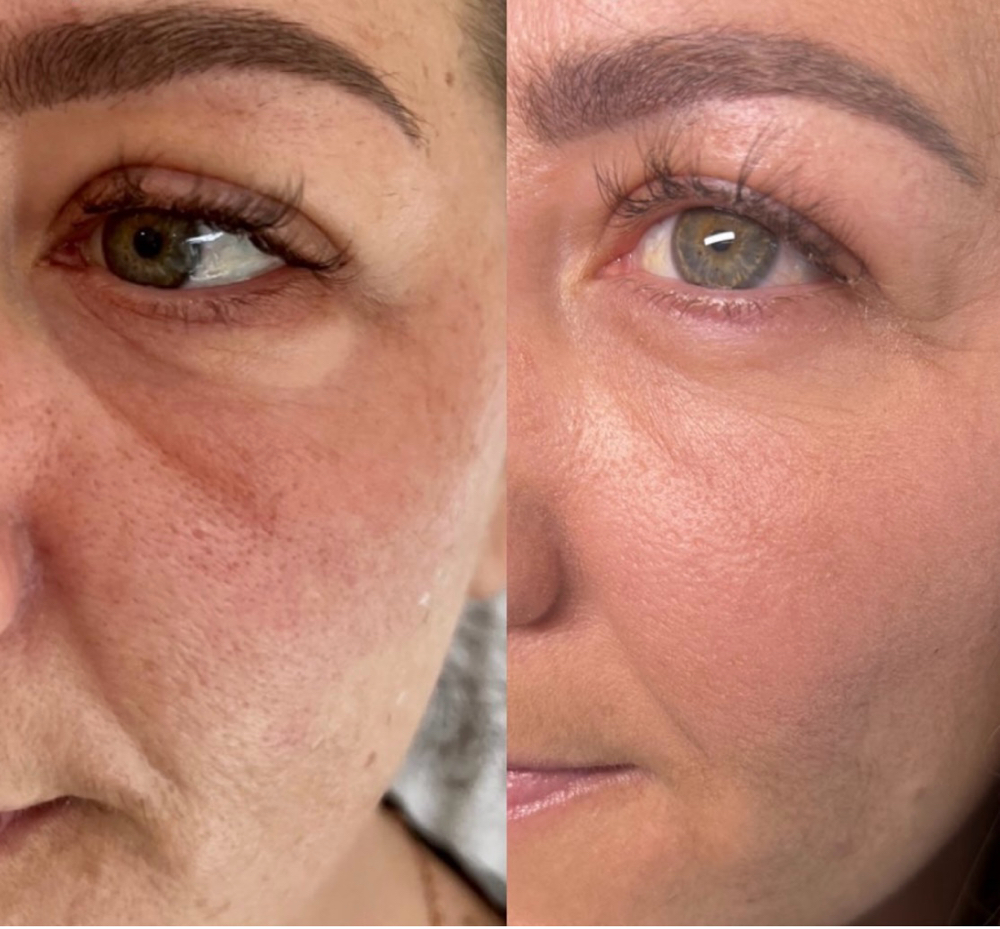 Undereye Biorevitalization