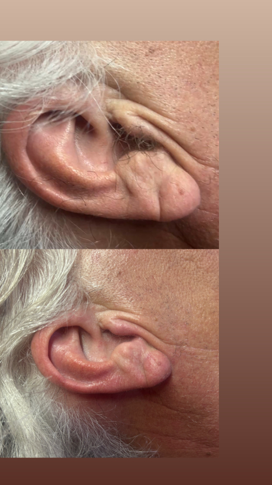 Ear waxing