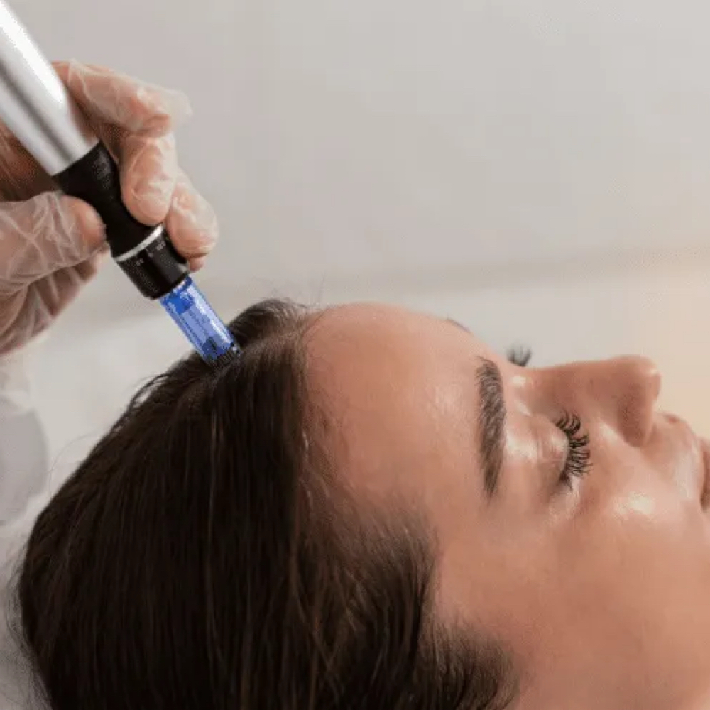 Scalp Microneedling (For Alopecia) at Kizmet Beauty in Vero Beach, FL
