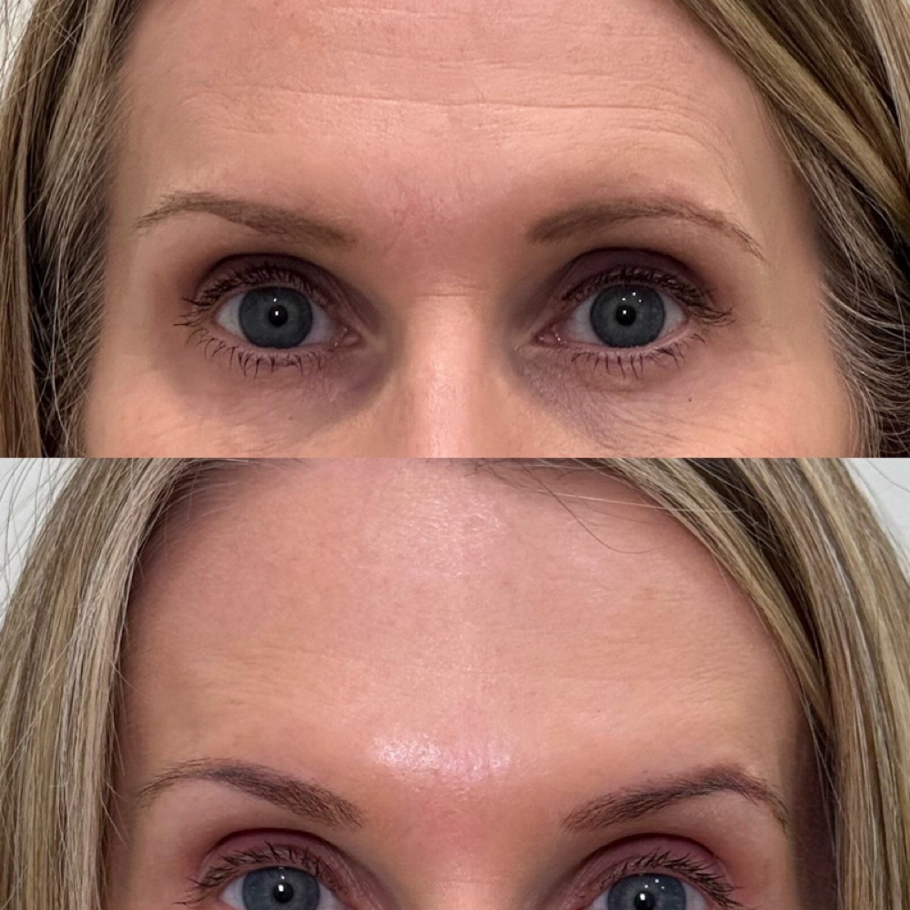Brow Lift at Kimspa&beauty in Dallas, TX