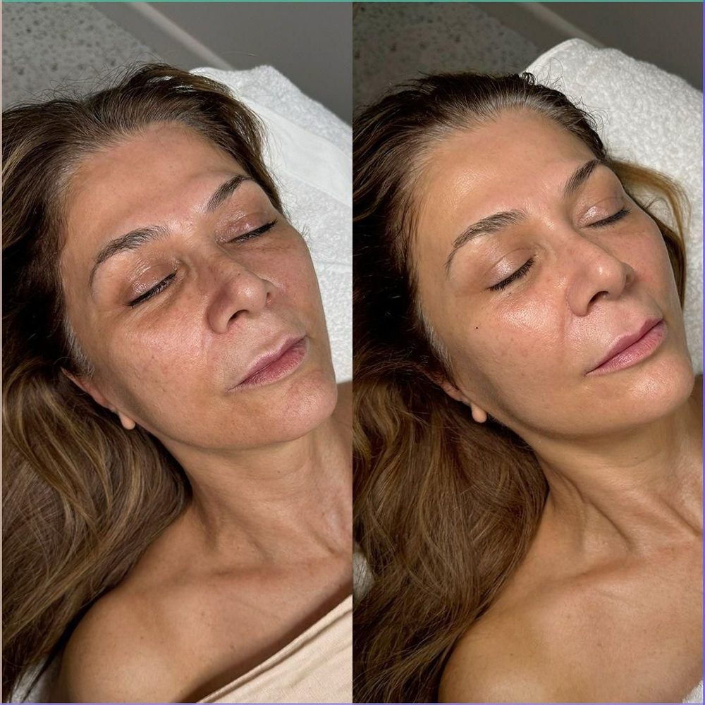 PRF FACIAL