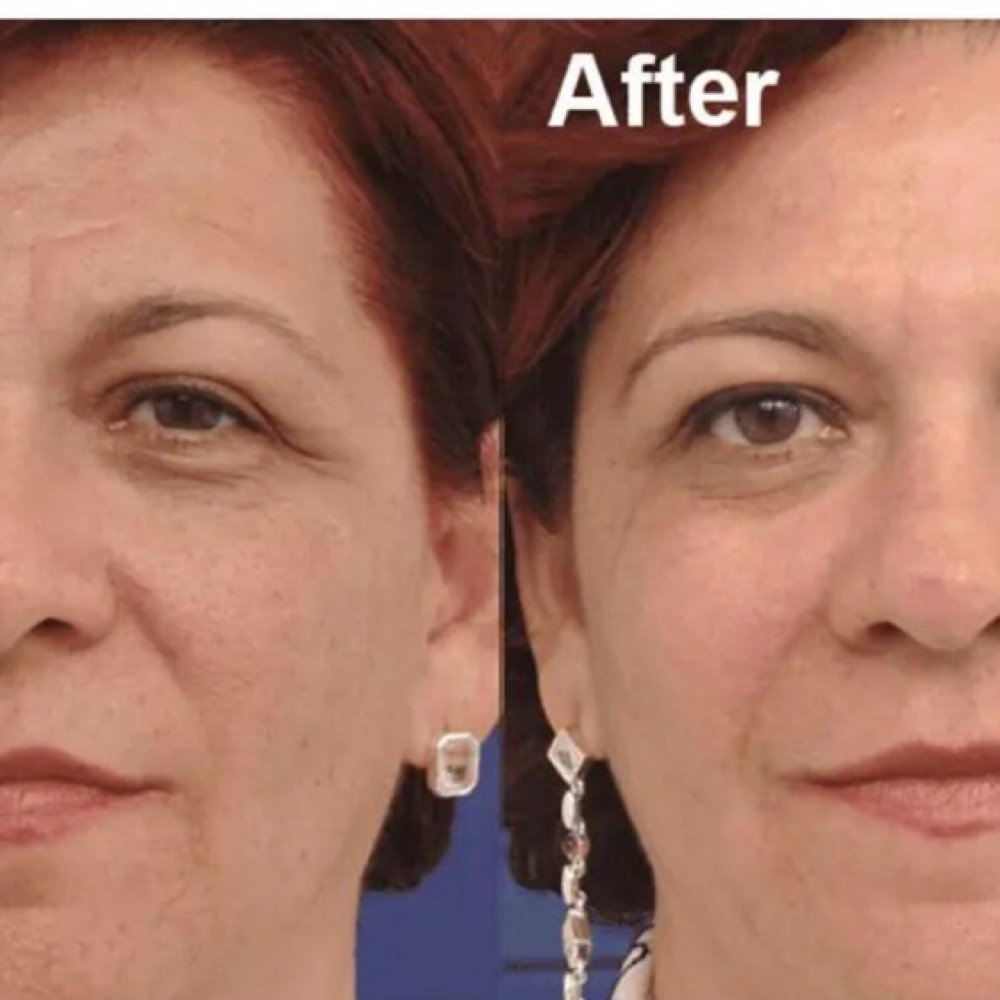 Skin Rejuvenation (6) at La Belle Studio by Soraya in Woburn, MA