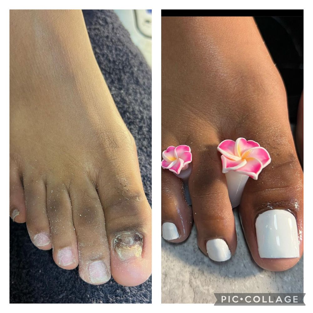 Acrylic Toe Reconstruction