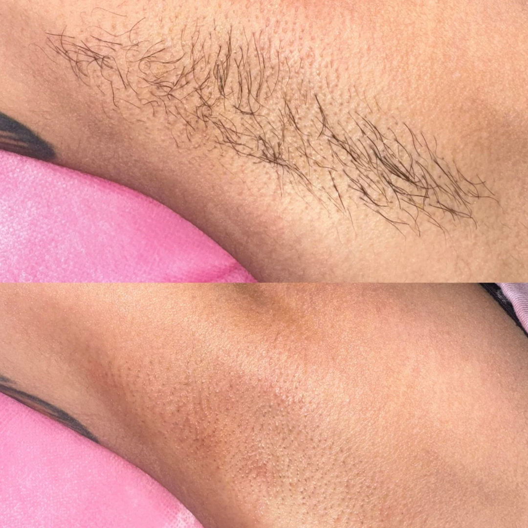 Underarms at Trale Beauty in Lewisville, TX