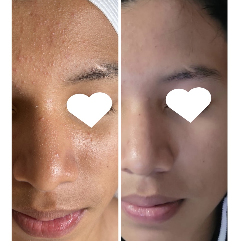 Teen Facial