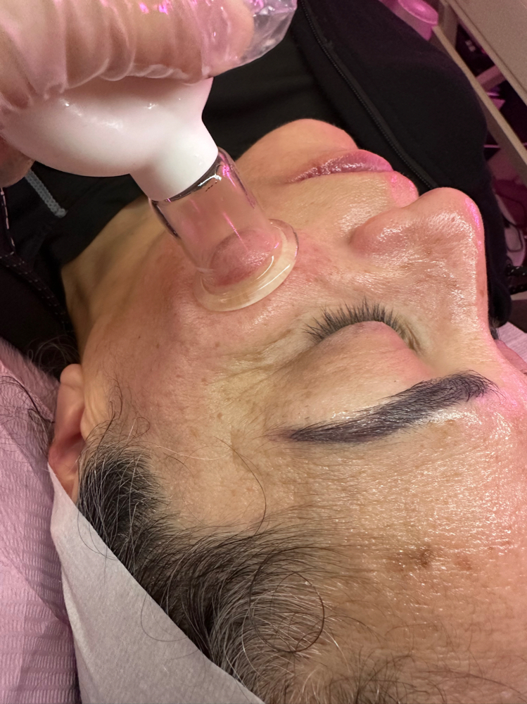Facial Cupping