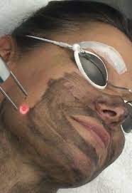 Carbon Laser Peel