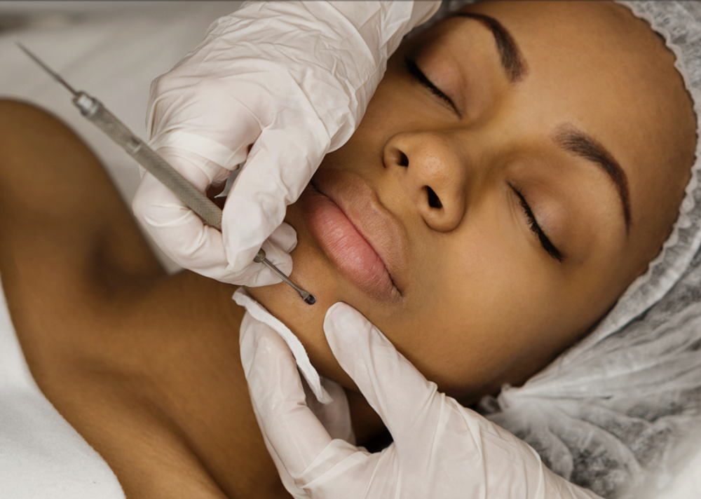 Extractions at MM Beautiful Skin in Redding, CA