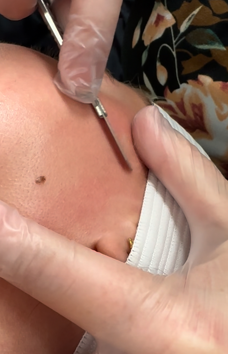 Dermaplane Facial