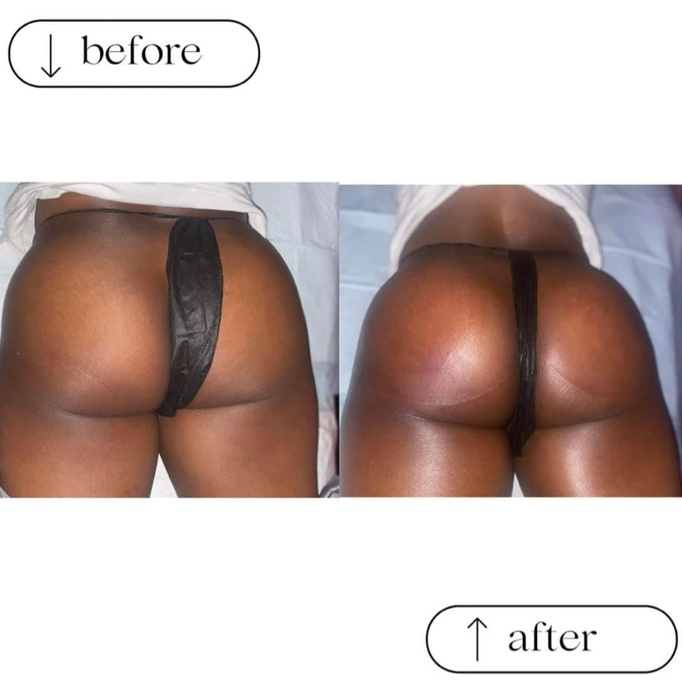 Non-invasive BBL(3 Session Package)
