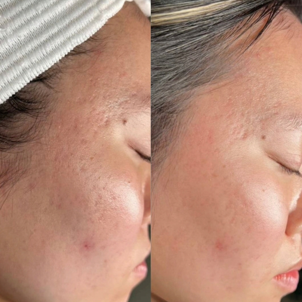 Bio-Microneedling