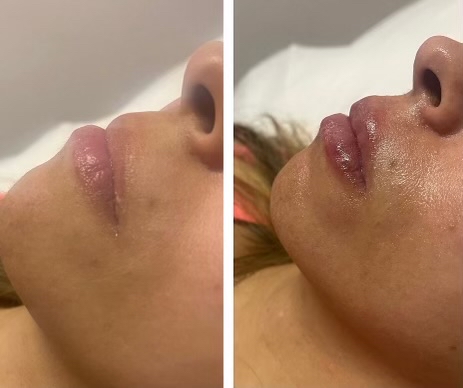 Lip filler