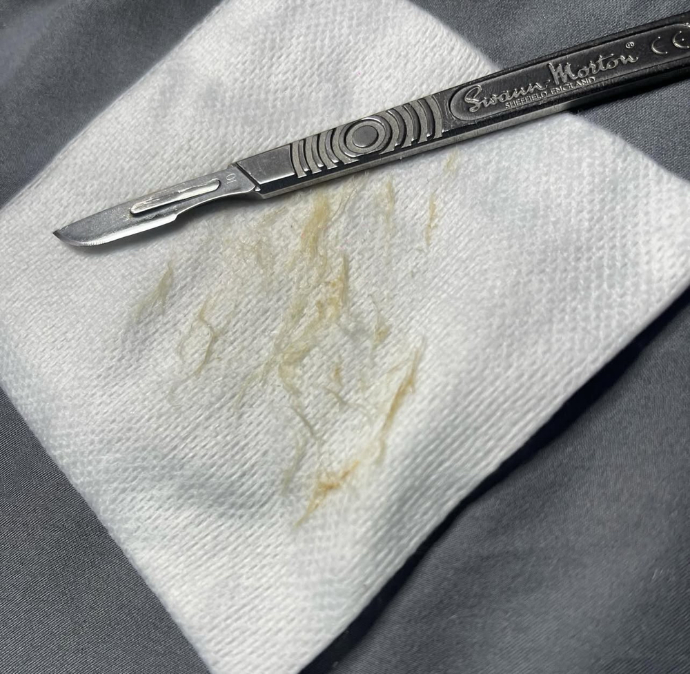 Dermaplane facial