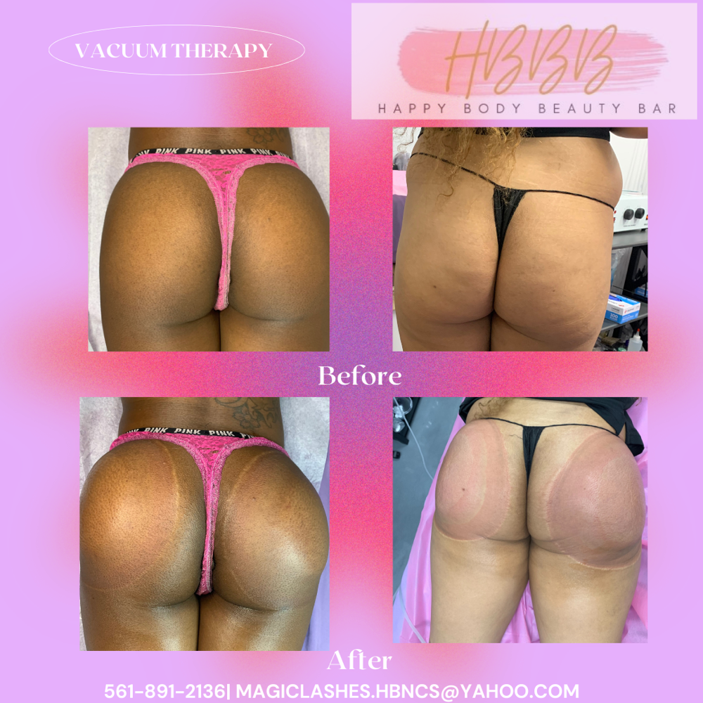 Non-Surgical Butt Lift