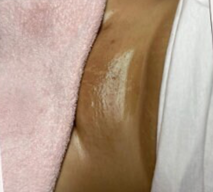 Brazilian wax