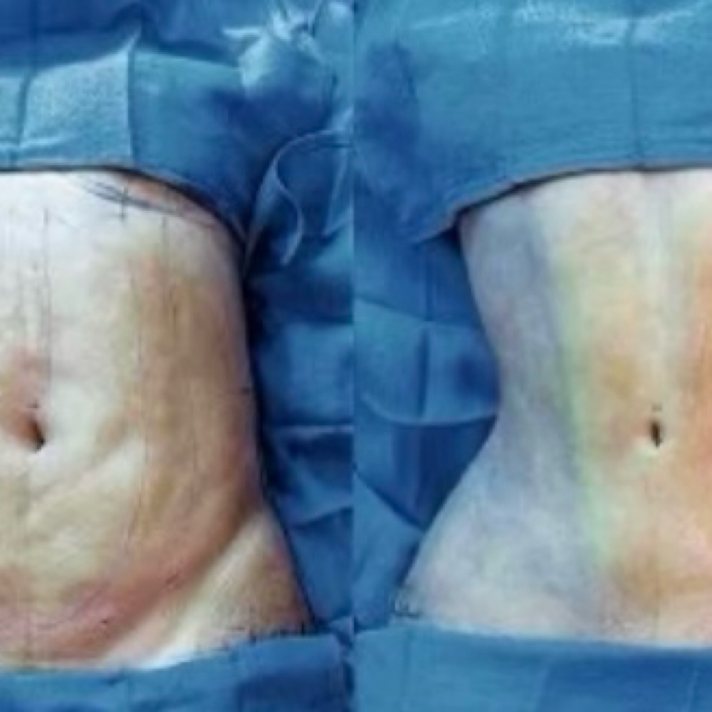 10x60 Post-Op Package at The Neurotherapeutics Massage and Bodywork  LLC in Goldsboro, NC