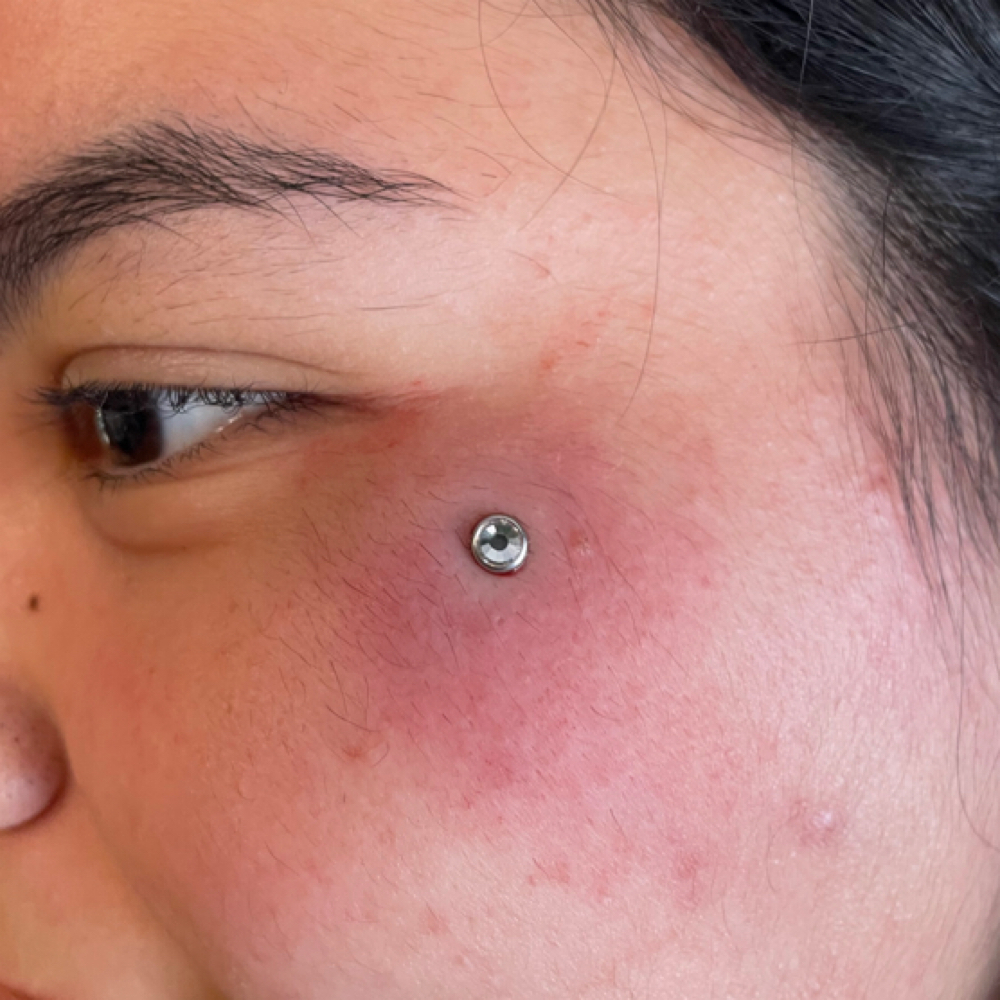 Surface Anchor (Dermal) at Piercedbyrayo in Clovis, CA