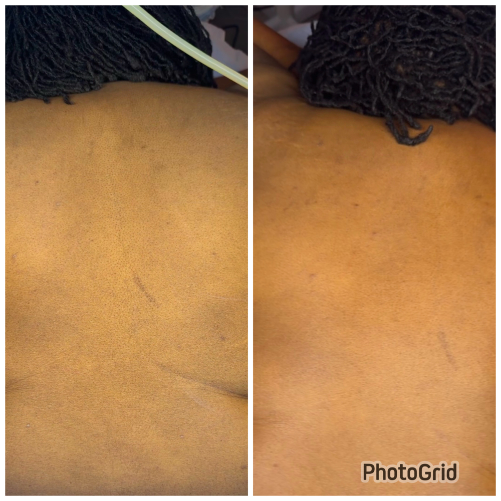 Back Facial