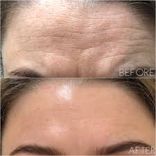 Forehead Lines