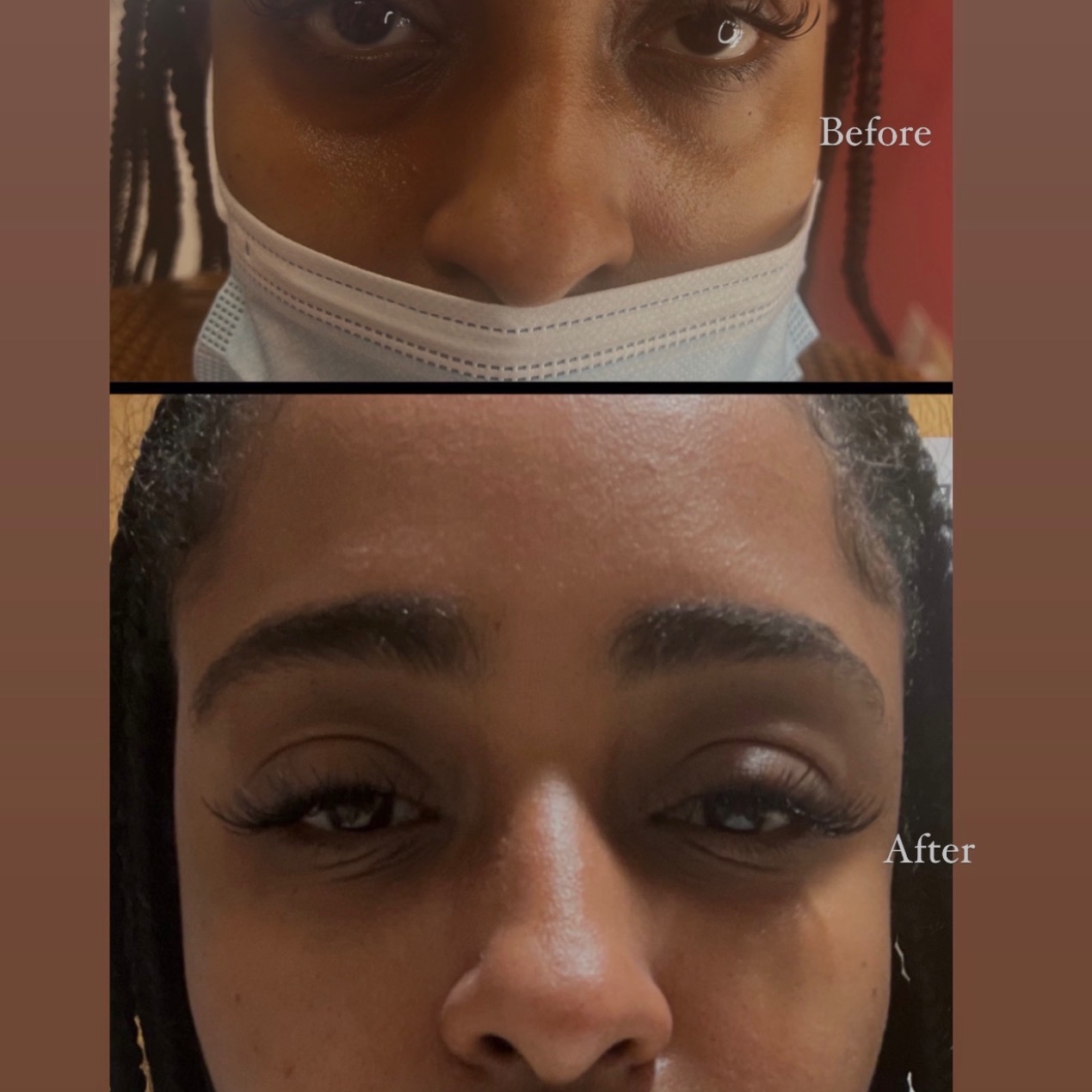 Under eye filler at TLN AESTHETICS MEDSPA in Lanham, MD