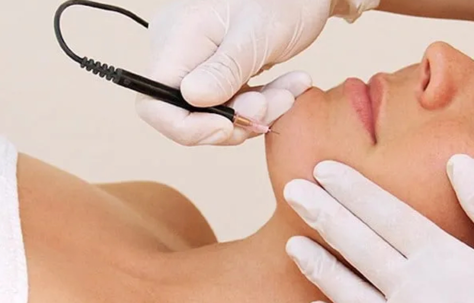 Electrolysis 2 Hr at ElectroGlo in Sandy, UT