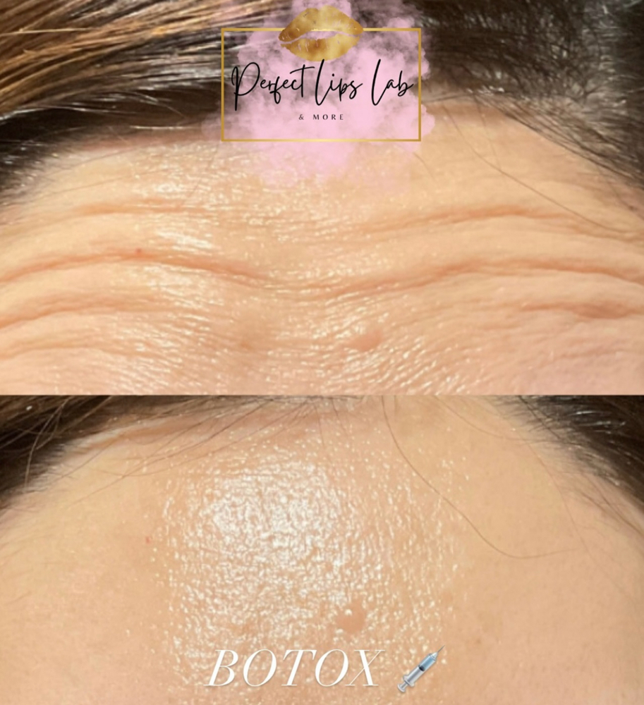 50 Units Botox Pkg