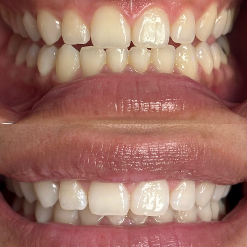 Express Whitening at Luna Smiles in Lexington, SC