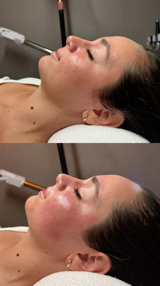 Deluxe Hydrafacial