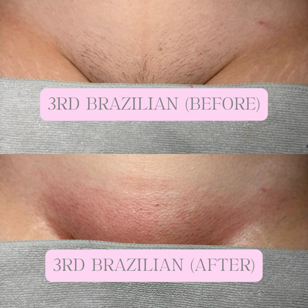 Brazilian Wax at Audra’s Aesthetic LLC in Milton, FL