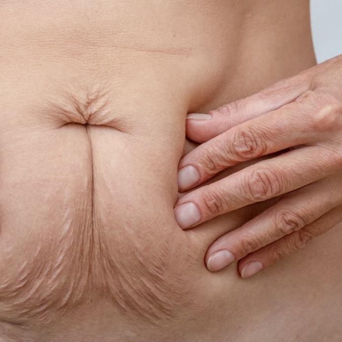 RF Skin Tightening Treatment