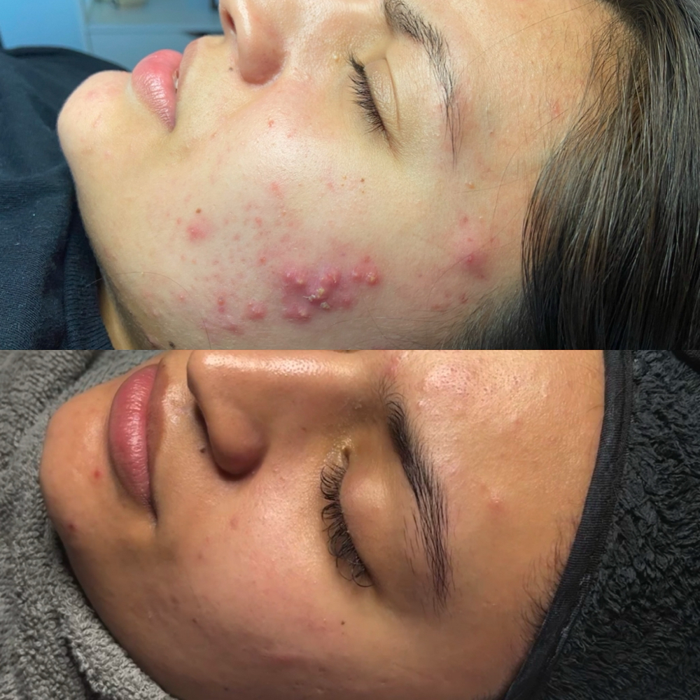 Acne Boot Camp (5 Sessions )
