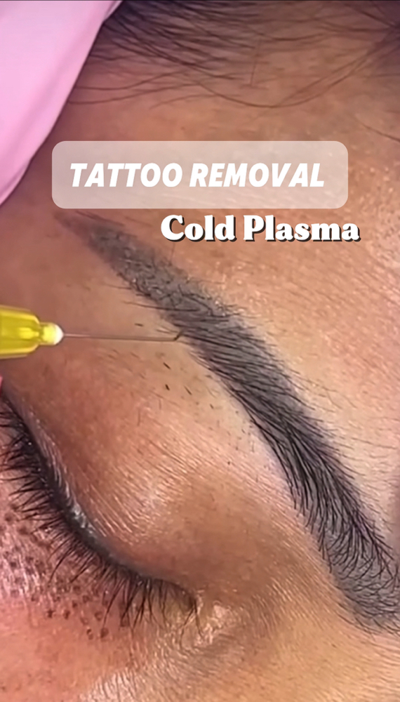 TATTOO REMOVAL- COLD PLASMA