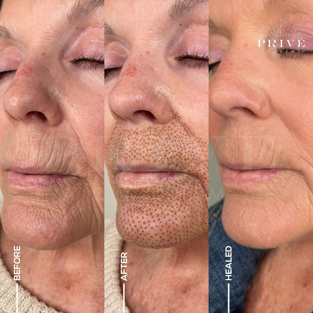 Upper Lip Lines Fibroblast