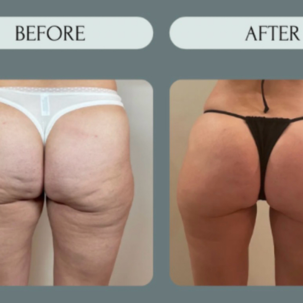 Cryotherapy Legs at LumenHeart with Chenoa in Loomis, CA