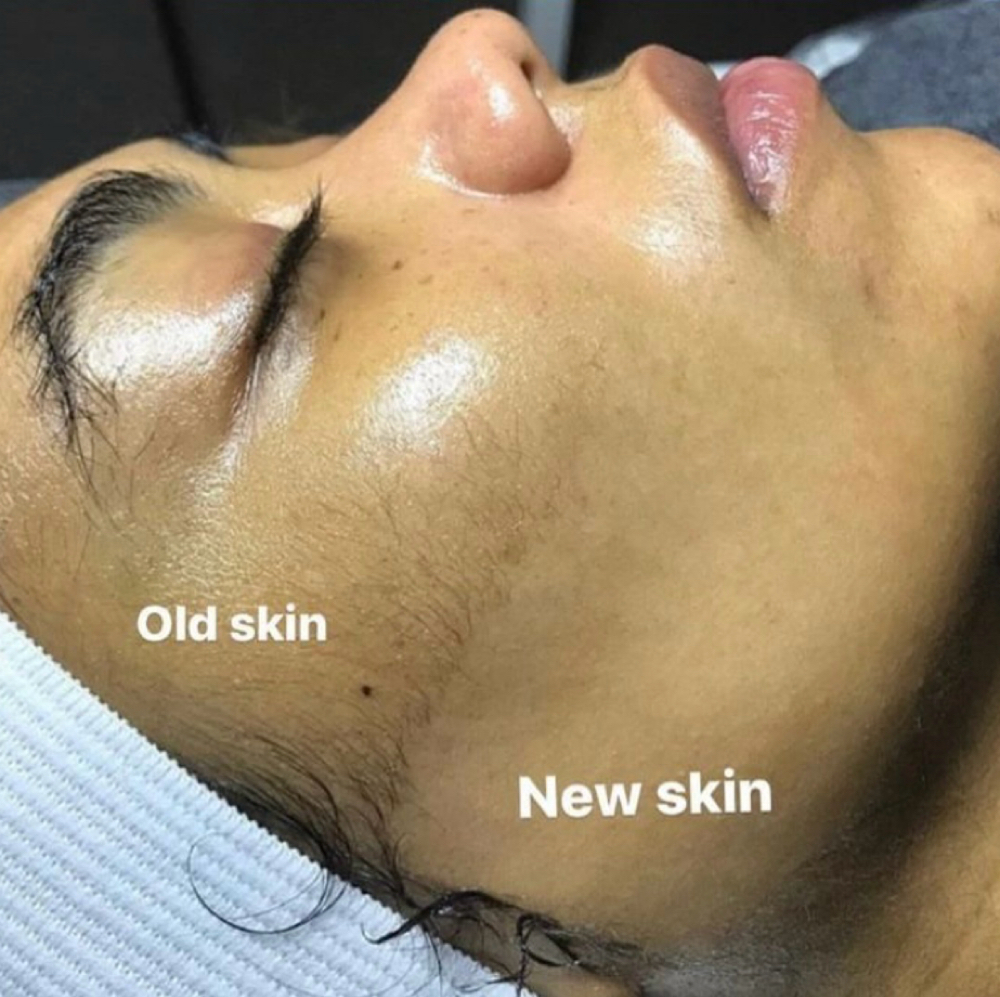Dermaplaning Facial at Esthetics Amor LLC in Wellington, FL