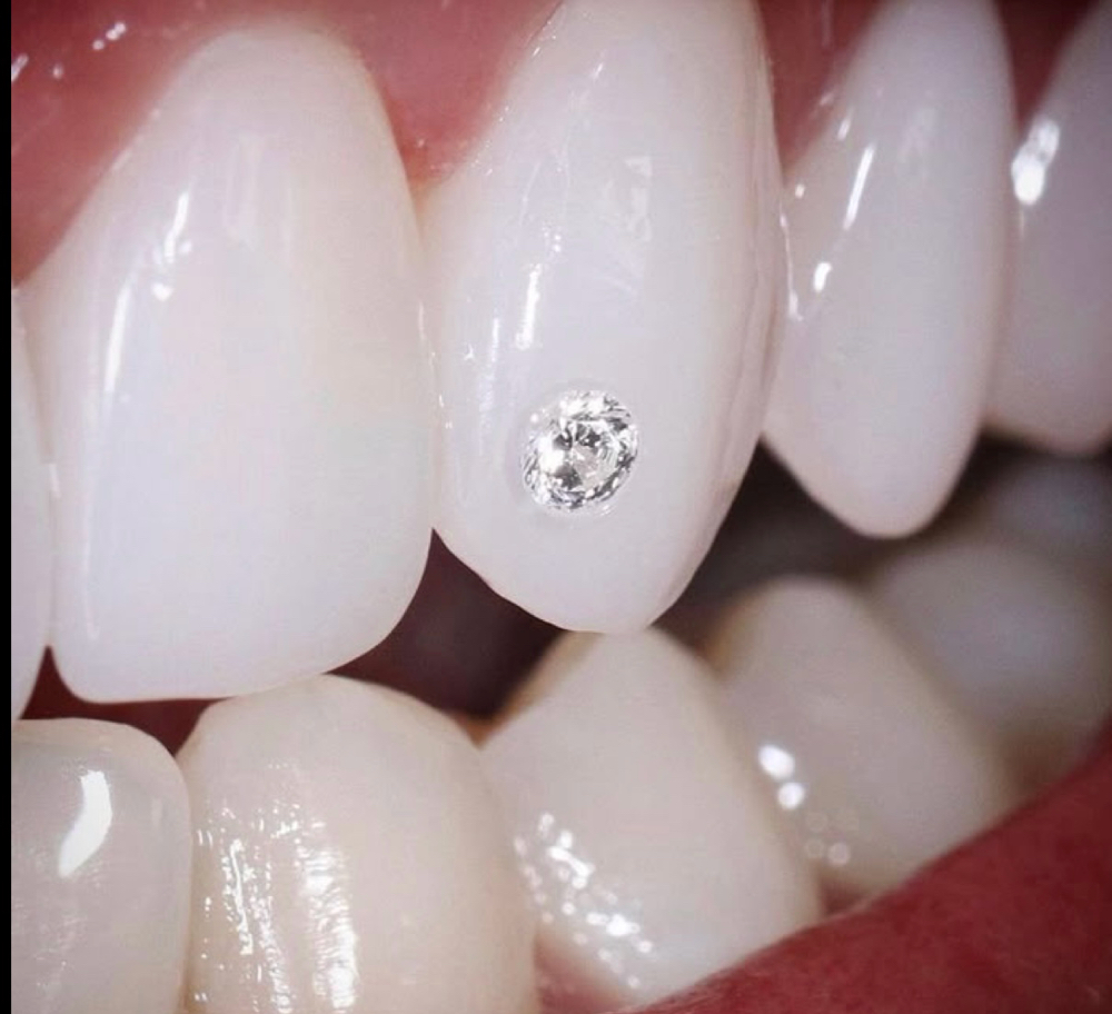 Tooth Gems, Kids Teens Or Adults!
