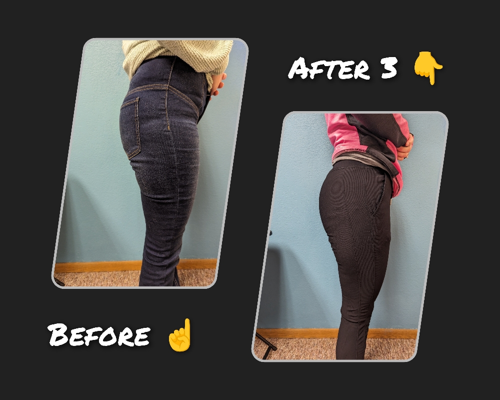 Vacuum Brazilian Butt Lift