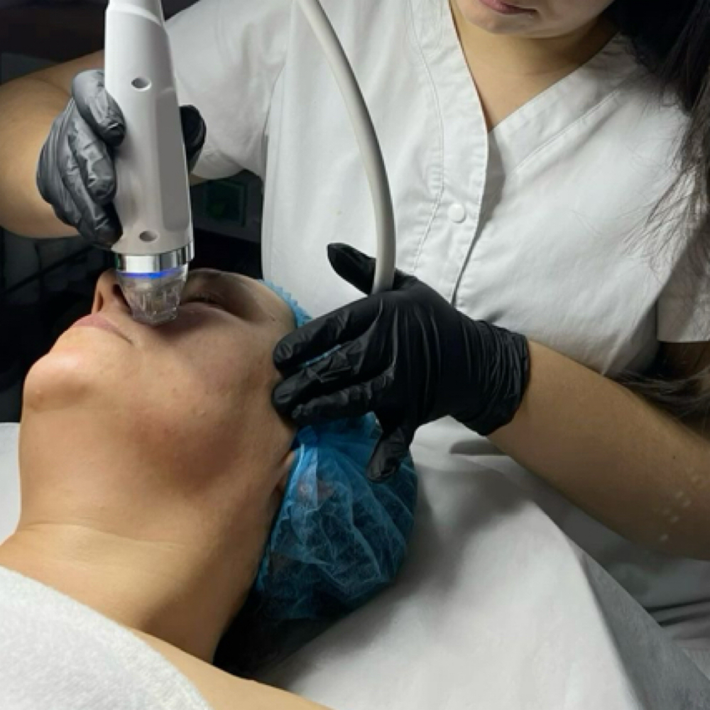 Laser RF Skin Resurfacing at Sharon Nicole Aesthetics in Patchogue, NY