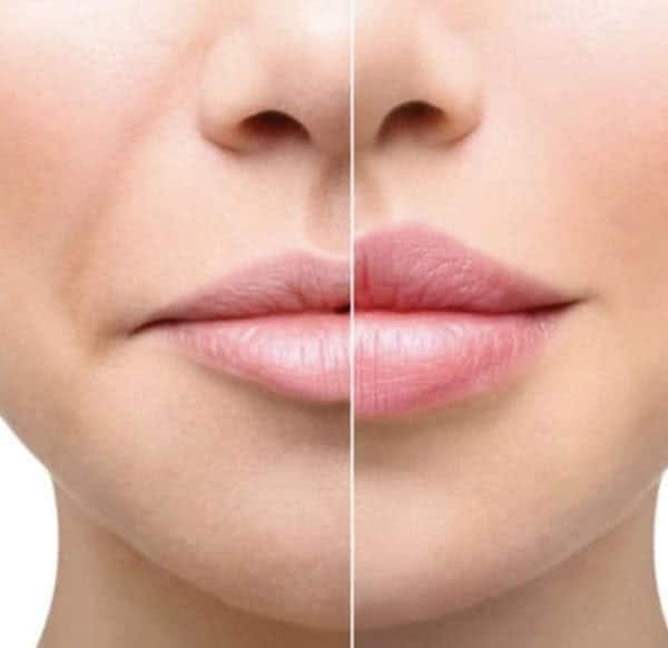 Hyaluron Pen Lip Enhancement 1ML