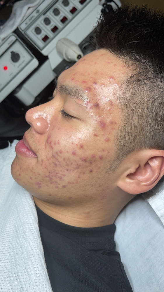 Teen Facial