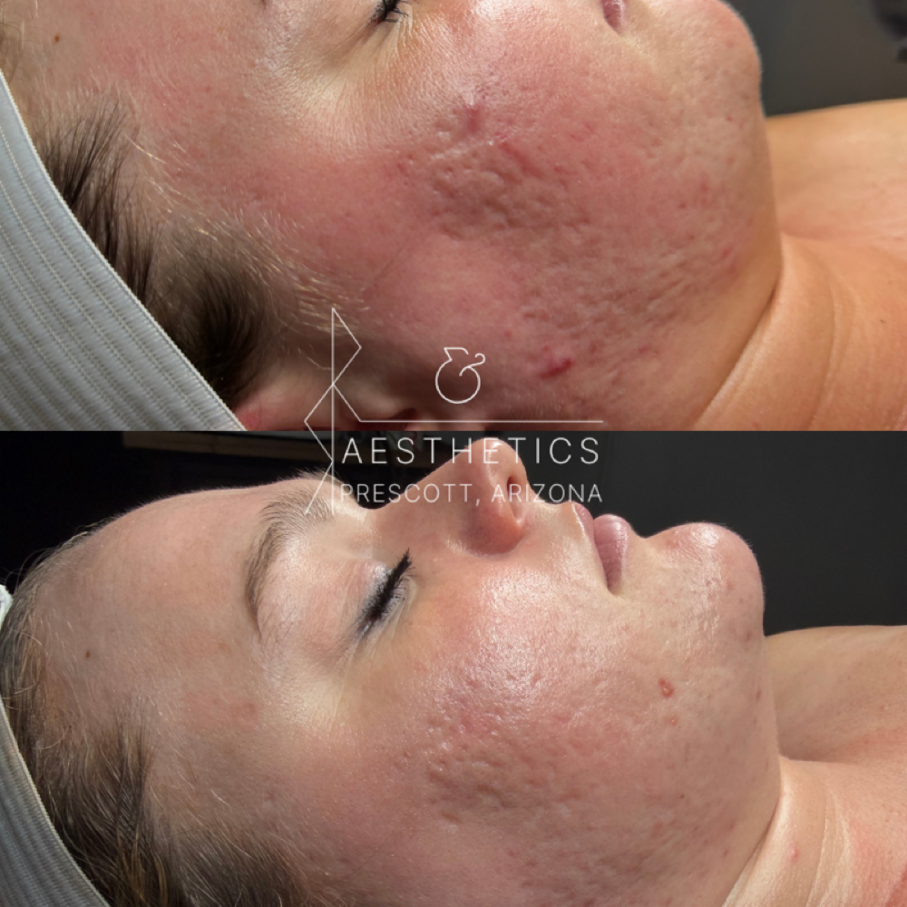Procell Microchanneling MD at R&R Aesthetics - Prescott, Arizona in Prescott, AZ